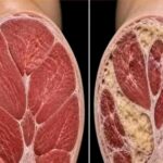 Bukan Sekadar Massa Otot Menurun, Myosteatosis Jadi Ancaman Tersembunyi Seiring Bertambahnya Usia